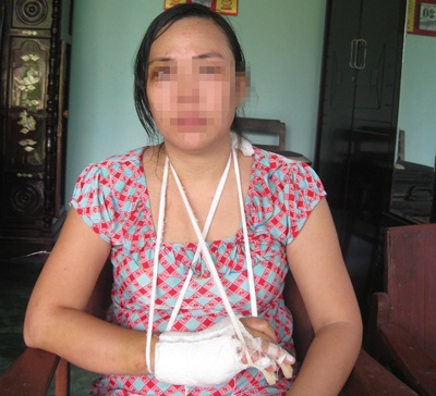 Phó phòng Tài nguyên - Môi trường bị tố đánh vợ dã man - 1 Cô giáo L. với vết thương cô tố cáo là do chồng gây ra