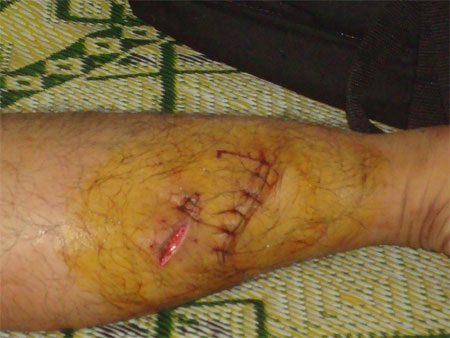 Hai du khách kinh hãi vì bị khỉ độc tấn công - 1 Hai vết thương do khỉ độc tấn công