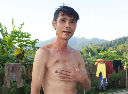 Cựu chiến binh Hoàng Văn Doãn với vết thương do bị bắn vào lưng phá ra đằng ngực.