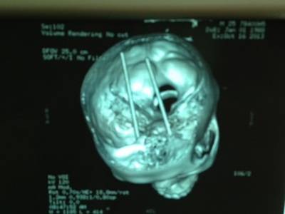Đôi đũa đâm xuyên sọ được chụp lại qua CT Scan.