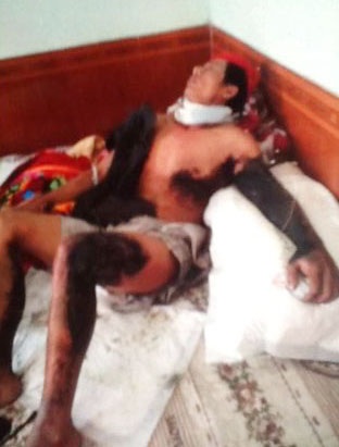 Bị điện giật bỏng nặng, nửa tháng sau mới được nhập viện