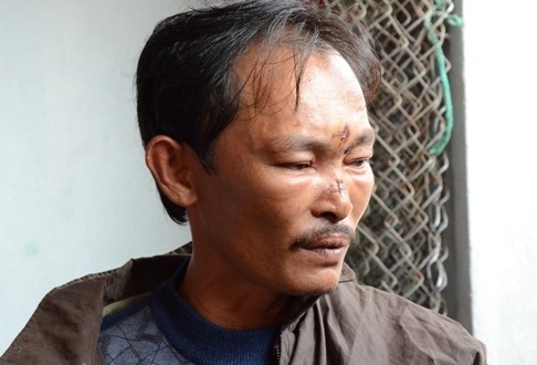 Nổ bình gas trên tàu cá: Nước biển xanh biến thành màu máu đỏ - 2 3 vết thương với nhiều mũi khâu trên mặt ngư dân Võ Tương