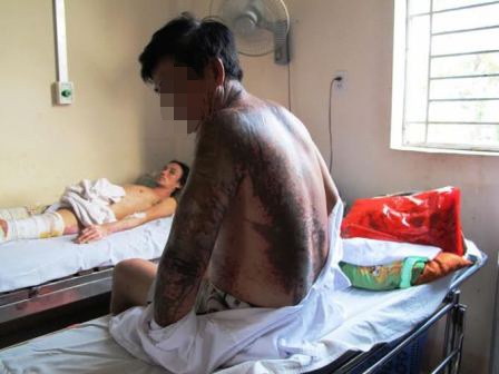 4 người bị tạt axit khi đang đi tập thể dục - 1 Ông Hòa (ngồi) bị phỏng axit diện tích 30% cơ thể ở vùng tay trái, lưng, cổ và mặt.