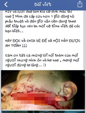 Vết thương trên mặt và lời cảnh báo cộng đồng của B trên mạng cá nhân