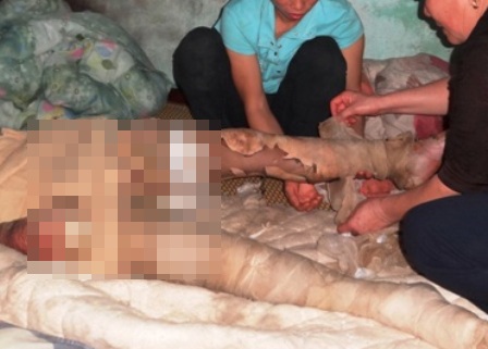 Mặc dù gia đình đã đưa nạn nhân đi chạy chữa nhưng anh Y vẫn không qua khỏi.