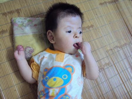 Bé trai bị Hội chứng Apert hiếm gặp được tài trợ phẫu thuật nước ngoài - 1 Cháu Trần Danh Tùng đứng trước cơ hội lớn được phẫu thuật tại Hàn Quốc