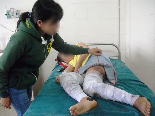 Chồng tạt xăng đốt vợ - 1 Chị T. đang điều trị tại Bệnh viện đa khoa Phú Yên