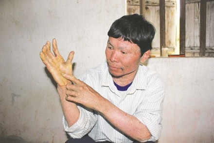 Gia tộc “giời đày” - 1 Bàn tay bị biến dị, nứt toác do căn bệnh tai ác.