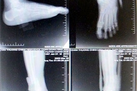 Móc túi bệnh nhân hàng tỉ đồng bằng cắt xén, tráo phim - 1 Một bệnh nhân chụp cổ bàn chân ở 4 tư thế đã bị cắt ghép phim.