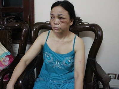Bà Hợp với thương tích trên người, kể lại sự việc với phóng viên.
