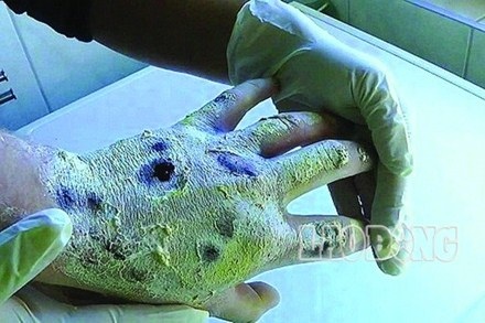 Những con nghiện bị krokodil “ăn thịt”