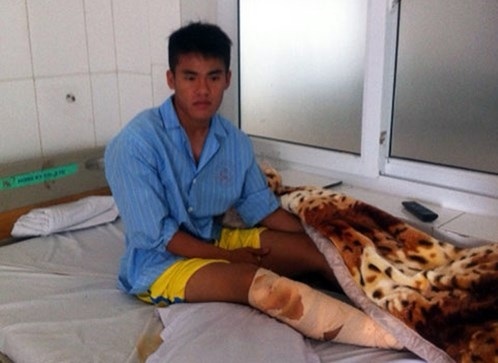 BHXH không giải quyết chế độ vì… đi tham gia phong trào! - 1 Một cầu thủ bóng đá bị gãy chân (ảnh minh họa)