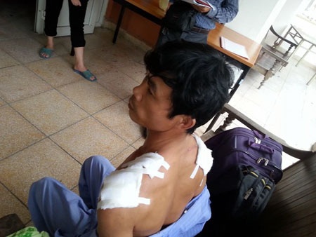 Những vết thương sâu 3cm trên hai vai ông Hải 