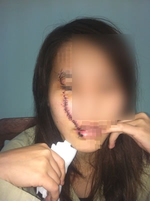 Chị T bị một nữ sinh dùng lam rạch vào mặt khi đang ngồi uống nước mía bên đường