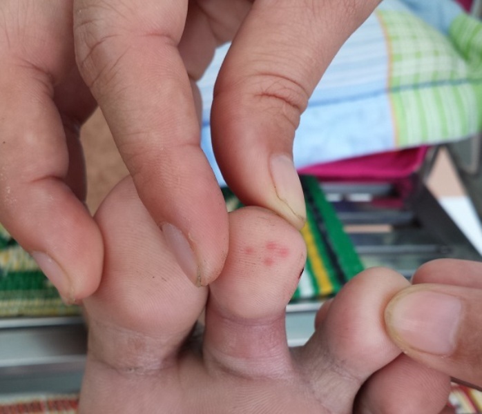 Vết răng rắn lục đuôi đỏ cắn