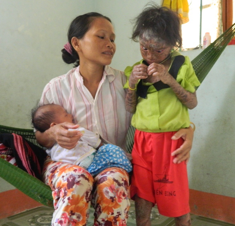 Cháu Hoa với bệnh vảy cá bẩm sinh hiếm gặp, với tần suất mắc bệnh chỉ 1/1 triệu trẻ