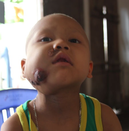 Cuộc chiến đấu của mẹ và con với tử thần mang tên "ung thư" - 4 Bé Nguyễn Văn Đa lúc sinh ra bụ bẫm, xinh xắn và khỏe mạnh như bao đứa trẻ bình thường