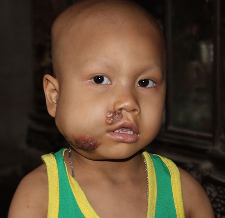 Cuộc chiến đấu của mẹ và con với tử thần mang tên "ung thư" - 3 Bé Nguyễn Văn Đa lúc sinh ra bụ bẫm, xinh xắn và khỏe mạnh như bao đứa trẻ bình thường