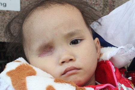 Bị ung thư võng mạc mắt, mắt phải của bé Phương Thảo đã phải múc bỏ để tránh di căn