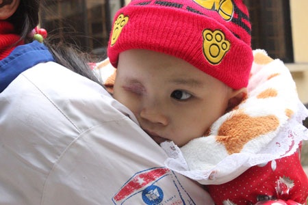 Cô bé một mắt nhưng vẫn tràn đầy nghị lực sống khiến ai nhìn cũng xót xa