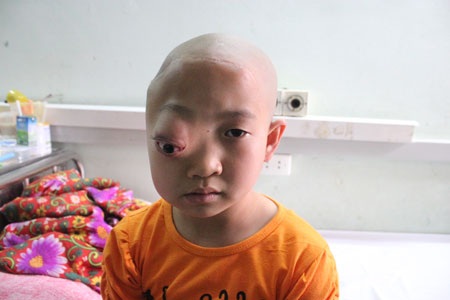 Bé 10 tuổi mơ tìm lại đôi mắt lành lặn