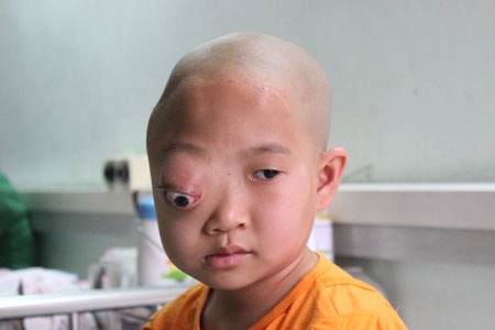 Bé 10 tuổi mơ tìm lại đôi mắt lành lặn