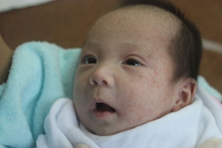 Cơ thể của bé Quang Anh đang bị chàm da cơ địa chưa được điều trị dứt điểm