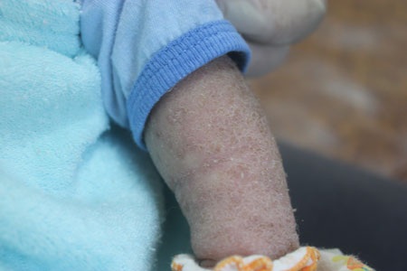 Cơ thể của bé Quang Anh đang bị chàm da cơ địa chưa được điều trị dứt điểm