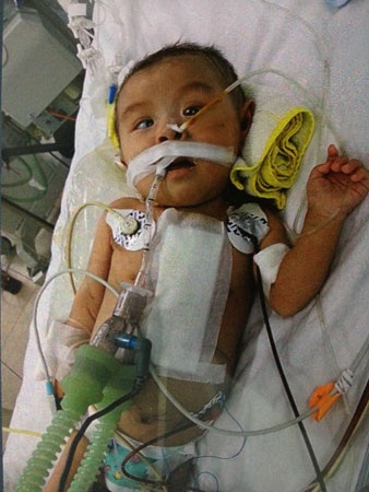 Sự sống bé 3 tháng tuổi mong manh với bệnh tim bẩm sinh hiểm nghèo