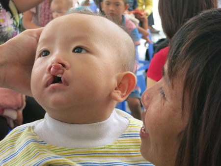 80 trẻ em có dị tật khe hở môi và vòm miệng được phẫu thuật miễn phí - 1 80 trẻ em có dị tật khe hở môi và vòm miệng được phẫu thuật miễn phí