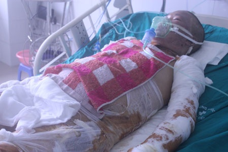 Bỏng gas hơn 50% cơ thể, tính mạng người mẹ trẻ nguy kịch - 2 Bỏng gas hơn 50% cơ thể, tính mạng người mẹ trẻ nguy kịch