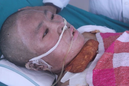 Bỏng gas hơn 50% cơ thể, tính mạng người mẹ trẻ nguy kịch - 3 Bỏng gas hơn 50% cơ thể, tính mạng người mẹ trẻ nguy kịch