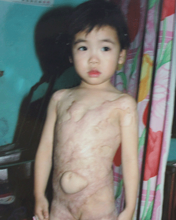 Di chứng nặng nề của bé Kiều Trang sau ca bỏng toàn thân - 3 Bé Kiều Trang bị bỏng nước sôi toàn thân lúc mới 2 tuổi hồi năm 2011