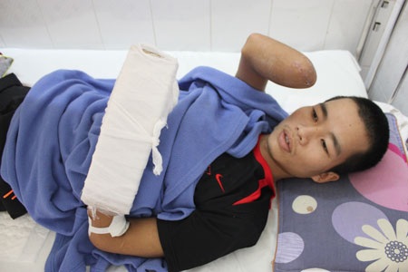 “Cứ nghe con gái gọi, em lại khóc” - 1 Cánh tay phải của anh Tùng đã phải cắt cụt, cánh tay trái và cả chân phải cũng khó giữ được