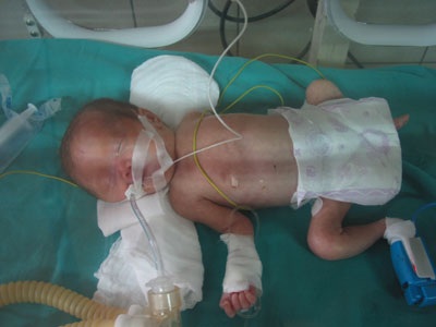 Bé Mận khi còn nằm cấp cứu tại Khoa Nhi, Bệnh viện Bạch Mai, Hà Nội cách đây 4 năm