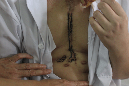 "Vết sẹo" đáng thương của cô giáo trẻ yêu nghề - 2 Vết sẹo đáng thương của cô giáo trẻ yêu nghề