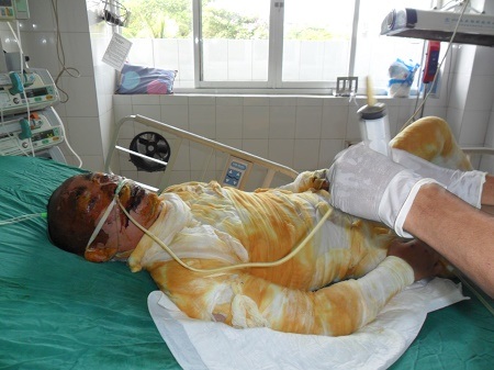 Nổ nồi hơi, bố và cháu trai tử vong, chồng thì nguy kịch - 1 Tính mạng của bệnh nhân Cao Huy Thật đang nguy kịch vì bỏng 60% cơ thể sau vụ tai nạn nổ nồi hơi