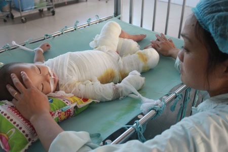 Chị Thư xót xa trước tai nạn bỏng mà con trai đang phải gánh chịu