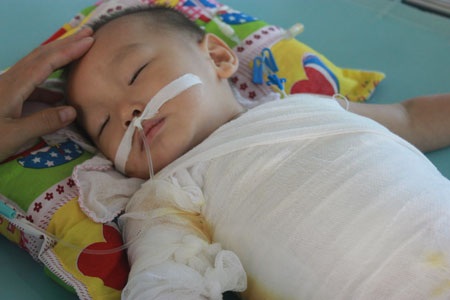 Bé Minh Quân nằm im với những hơi thở khó khăn do ca bỏng nước sôi gây ra trên khắp cơ thể