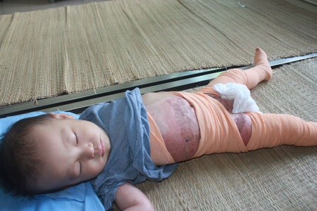 Hơn 68 triệu đồng đến với bé Minh Quân - 1 Ca bỏng nước sôi để lại nhiều di chứng trên cơ thể bé Minh Quân