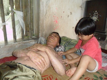Nỗi đau đớn của người đàn ông mắc bệnh vảy nến hơn 20 năm - 1 Mắc bệnh vảy nến 20 năm nay, cơ thể anh Mừng ngày một tàn tạ với chi chít vết thương