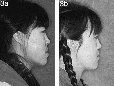 Trước và sau khi điều trị niềng răng móm.