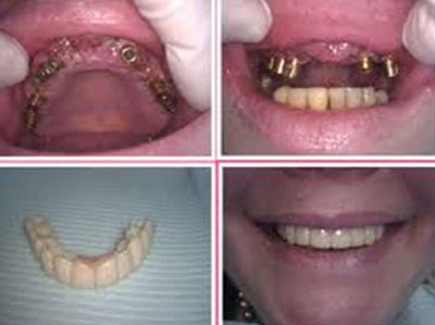 Mọc răng ở tuổi 60 - tại sao không? - 2 Vậy quy trình cấy Implant như thế nào? Tỷ lệ thành công ra sao?