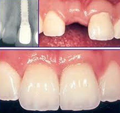 Mọc răng ở tuổi 60 - tại sao không? - 1 Vậy quy trình cấy Implant như thế nào? Tỷ lệ thành công ra sao?