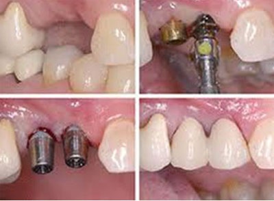 Mọc răng ở tuổi 60 - tại sao không? - 3 Vậy quy trình cấy Implant như thế nào? Tỷ lệ thành công ra sao?