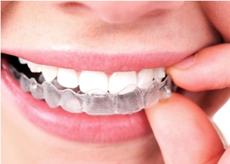 Niềng răng không mắc cài - Phương pháp cho người ở xa - 2 Niềng răng không mắc cài - Phương pháp cho người ở xa