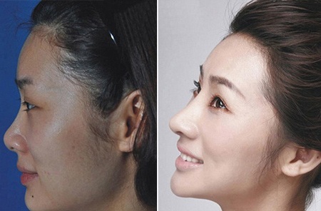 Những ca phẫu thuật thẩm mỹ "gây choáng váng" của phụ nữ Trung Quốc - 6 Mi Vân