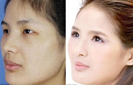 Những ca phẫu thuật thẩm mỹ "gây choáng váng" của phụ nữ Trung Quốc - 8 Mi Vân