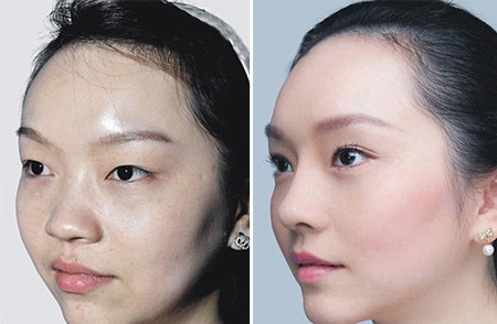 Những ca phẫu thuật thẩm mỹ "gây choáng váng" của phụ nữ Trung Quốc - 9 Mi Vân