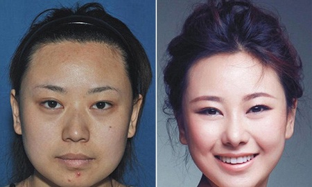 Những ca phẫu thuật thẩm mỹ "gây choáng váng" của phụ nữ Trung Quốc - 4 Xu hướng phẫu thuật thẩm mỹ làm đẹp của phụ nữ Trung Quốc